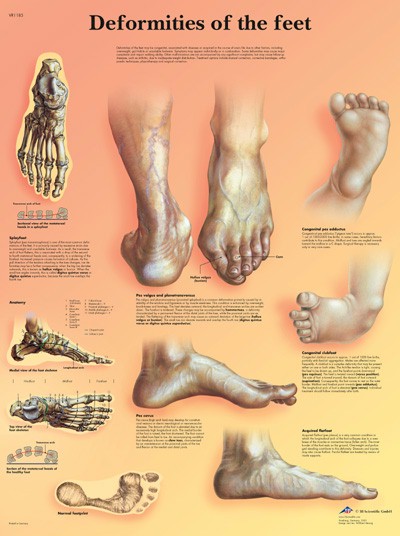 Wandkaart: Deformities Of The Feet