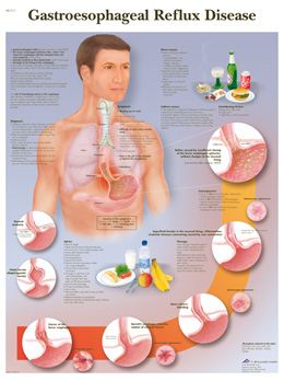 All Products - Wandkaart: Gastroesophageal Reflux Disease
