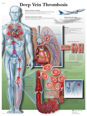 All Products - Wandkaart: Deep Vein Thrombosis