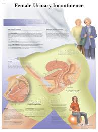 Wandkaart: Female Urinary Incontinence